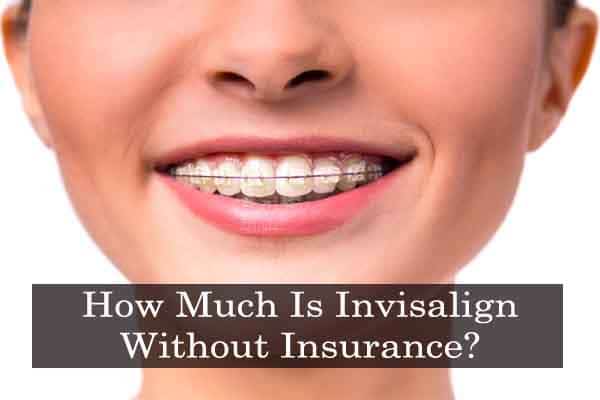 How Much Is Invisalign Without Insurance?